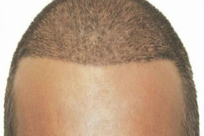 Saç Ekimi Aşamaları Nelerdir?