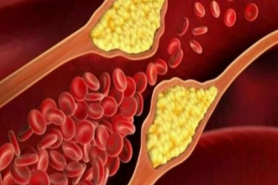 Yüksek seviyede kolesterol demansa mı yol açıyor?