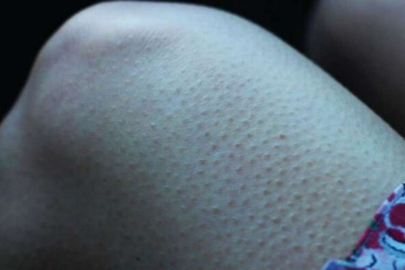 Tavuk derisi sorunu nasıl geçer?