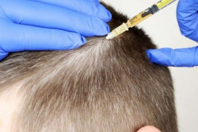 Türkiye'nin sağlık turizminde en çok saç ektirmeye geliyorlar!