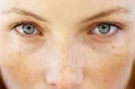 Sivilce kızarıklığı neden olur ve en kolay nasıl geçer?