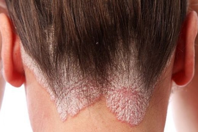 Hindistan cevizi yağı sedef hastalığını tedavi edebilir mi?