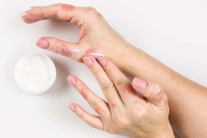 Sonbaharda alerjik egzamaya dikkat