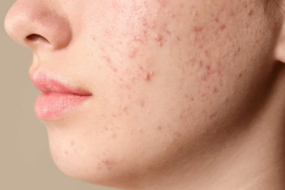 Cildiniz yanabilir...