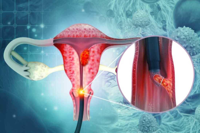 Rahim Ağzı Kanserinin Erken Belirtileri ve HPV'nin Rolü