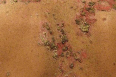 Vücudu Saran Hastalık: Pemfigus Nedir, Tedavisi Var Mı?