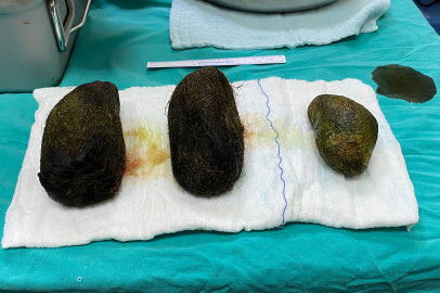 Karın Ağrısı Şikayetiyle Gitti, Karnından 2 Kilo Saç Çıktı.