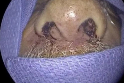 Burun Ağrısı Şikayetiyle Hastaneye Gitti, Burnundan 150 Böcek Çıktı