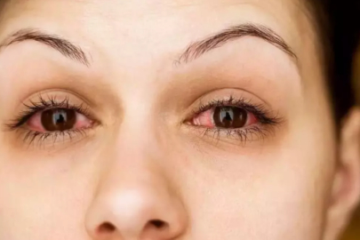 Göz Enfeksiyonları: Belirtiler, Tipler, Komplikasyonlar ve Tedavi