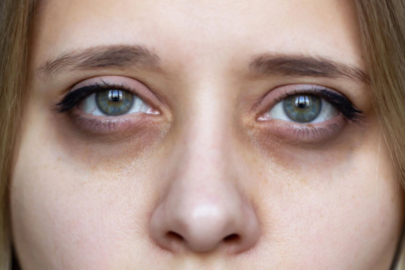  Göz Altı Morluklarına Elveda Demenin Sihirli Formülü: Gül Suyu ve Süt Maskesi!