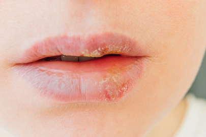 Uçuğu Geçirici Doğal ve Tıbbi Yöntemler