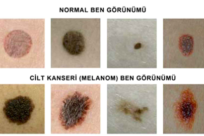 Cilt Kanseri Tehlikesine Dikkat: Kanserli Benleri Tanımlamanın 5 Yolu!