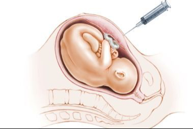 Amniyotik Sıvı Sorunları: Belirtiler, Tedavi ve Önleme Yöntemleri