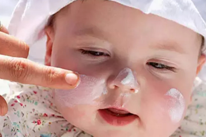 Uzmanlardan önemli uyarı: Yanık tedavisinde yoğurt kullanımı zararlı olabilir!