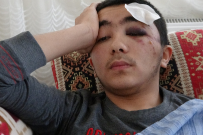 Cami Yolunda Önüne Çıkan Köpeklerden Kaçarken Düşmesi Sonucu Kafatası Çatladı