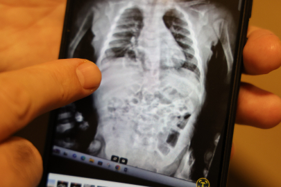 Sık sık akciğer enfeksiyonu geçirip zatürre tedavisi görün çocuğun hastalığının altından bambaşka neden çıktı