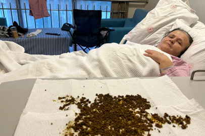 Manisa'da safra kesesinden ameliyat olan bir kadından 20 binin üzerinde taş çıkarıldı