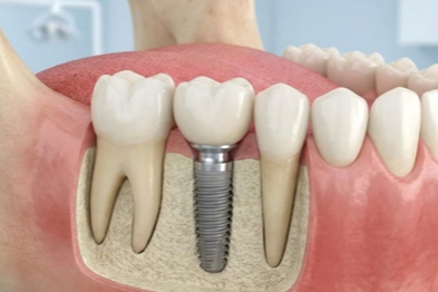 Diş İmplantı ne kadar dayanıklıdır?