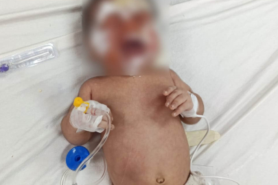 Şanlıurfa'da Çıkan Yangında 2 Aylık Bebek Yanarak Yaralandı