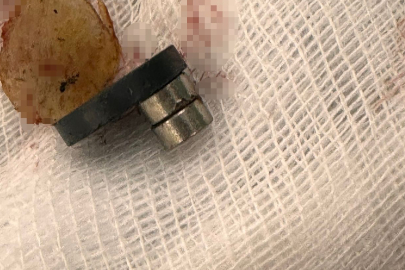 1,5 Yaşındaki Bebeğin Yuttuğu 3 Mıknatıs Bağırsakta Delik Açtı