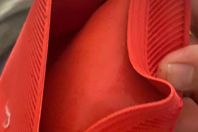 Su torbası faciası, genç kızın vücudunun yüzde 25'i yandı