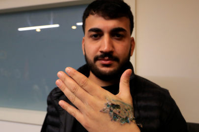 Dövmesini sildirmek için gittiği güzellik merkezi elinden ediyordu