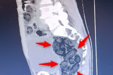 Batman’da Uyuşturucu Operasyonu:  Midesinden 64 Parça Uyuşturucu Çıktı