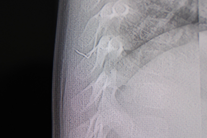 Bebeğin Sırtından Çıkan Dehşete Düşürdü!