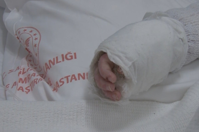 Küçük Çocuk Feci Şekilde Yandı!