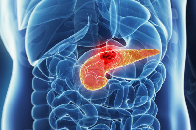 Yeni Kan Testi Pankreas Kanserini Erken Aşamada Tespit Edebiliyor