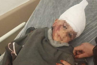 Kayseri’de başıboş köpeğin saldırısına uğrayan çocuk 3 operasyon geçirdi