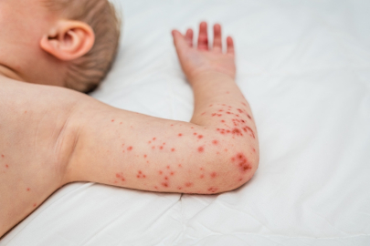 Kızamık salgını: 113 çocuk öldü