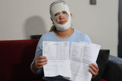 Güzelleşmek uğruna gittiği merkezde yüzü yandı