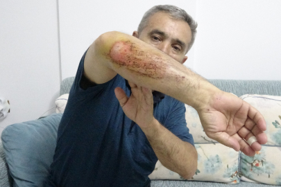 Motosikletli gezi kabusa döndü, baba ve otizmli oğlu köpek saldırısında yaralandı