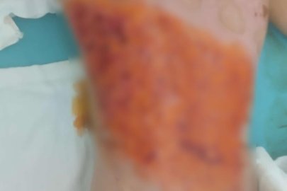 Akran zorbalığı iddiası: 12 yaşındaki çocuğun sırtını kolonya ile yaktılar